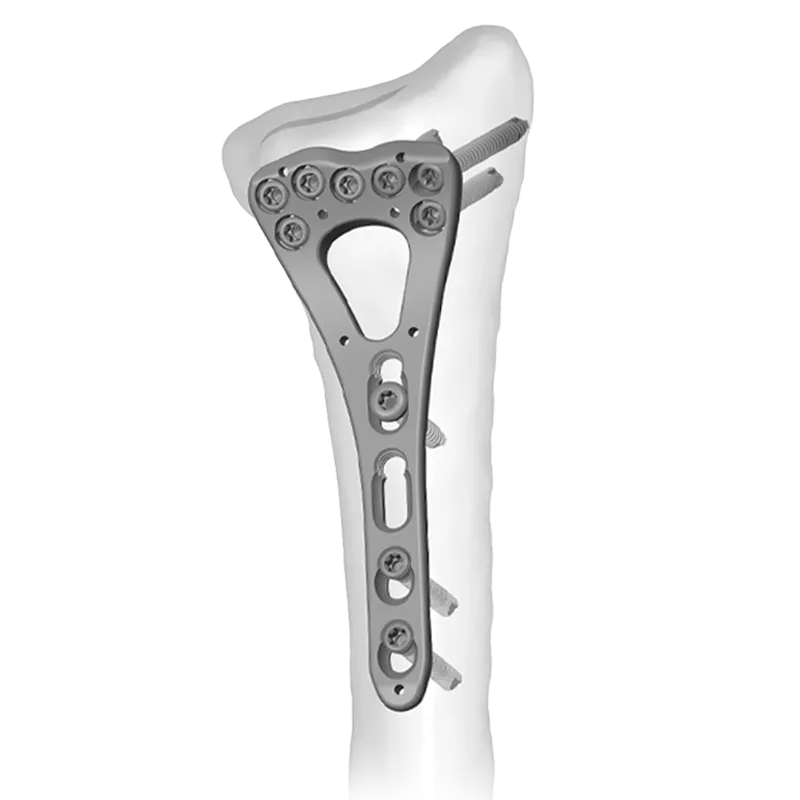 Locking Distal Radius Plates with bone