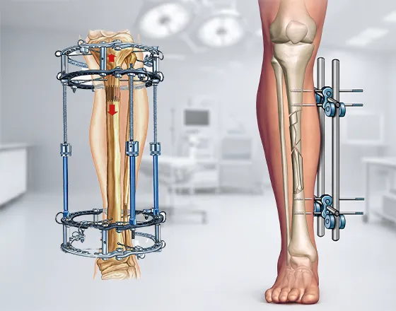 External Fixation System