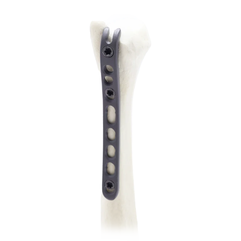 Distal Ulna Plates with bone
