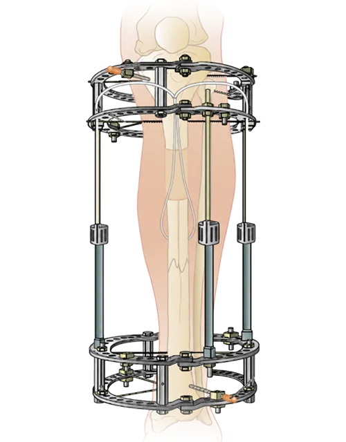 External Fixation System
