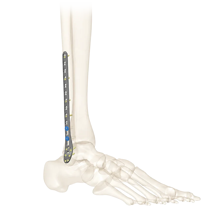 Fibula Plates with bone Fibula Plate