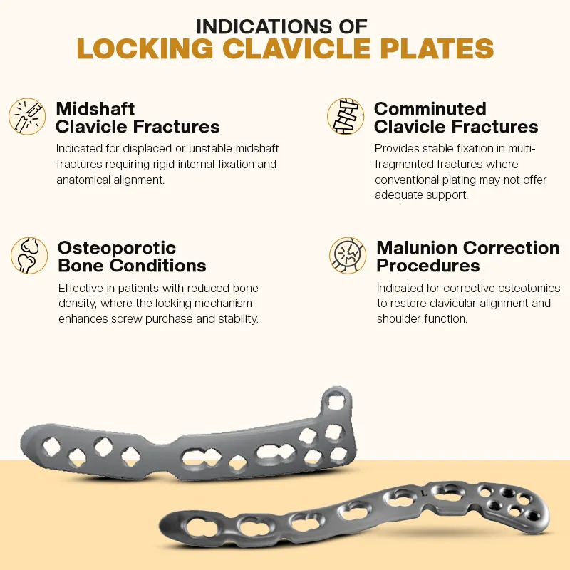 Key Indications of the Clavicle Plating System