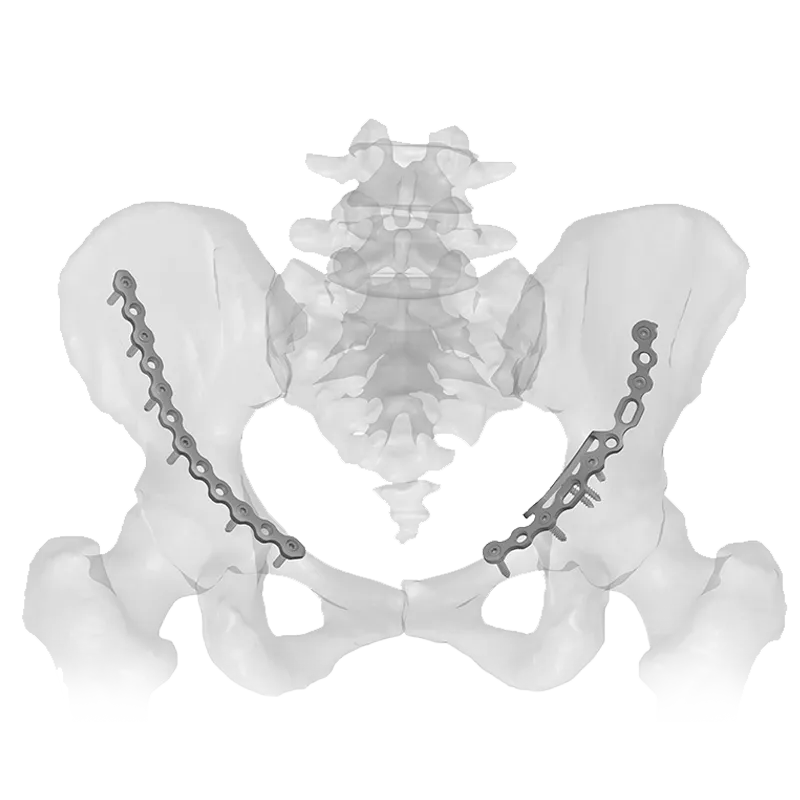 Low-Profile-Pelvic-Locking-Plate-System