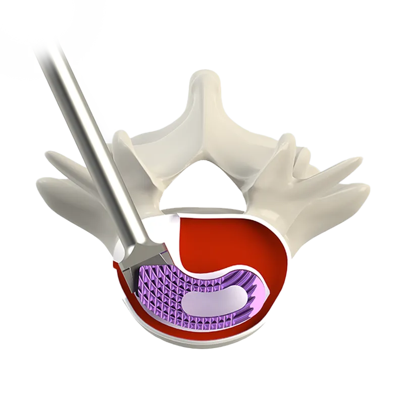 transforaminal lumbar interbody fusion cage