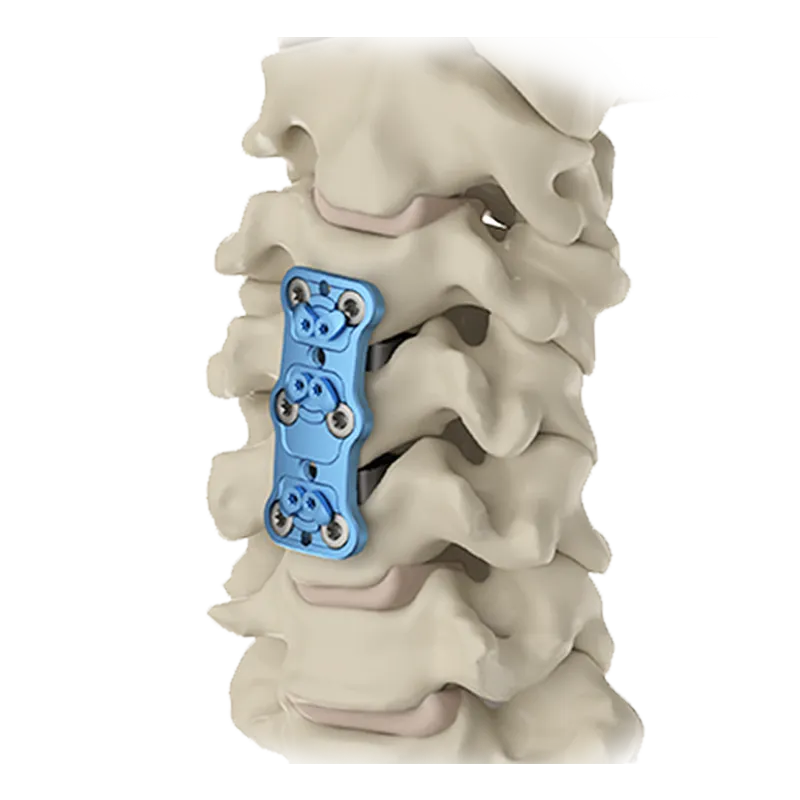 Anterior Cervical Fusion