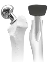 Bipolar and Radial Head Prosthesis front image