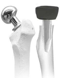 Bipolar and Radial Head Prosthesis
