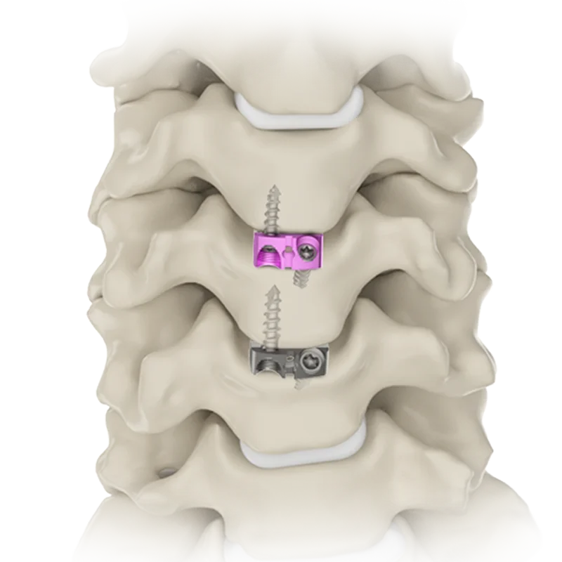Cervical Cage