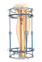 external fixation system front image