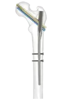 intamadullary nail front image