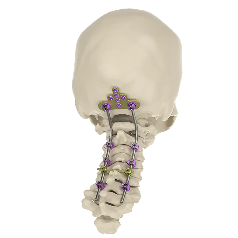 occipital bone Implant