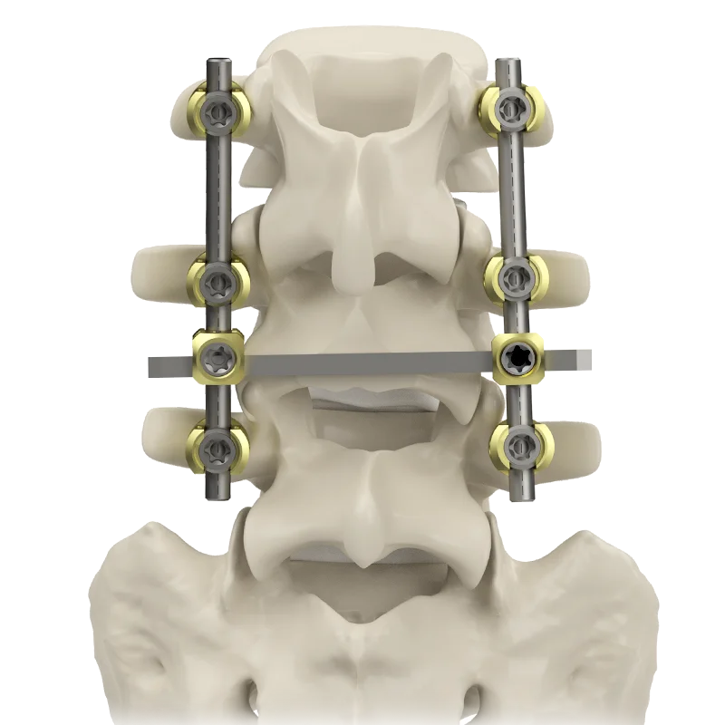 pedicle screws fixation