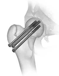 Cannulated Screws image